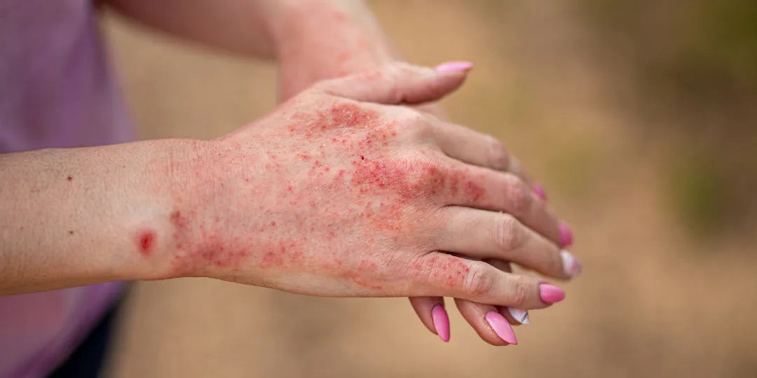Eczéma et peau sensible: adoptez des routines naturelles pour plus de confort au quotidien