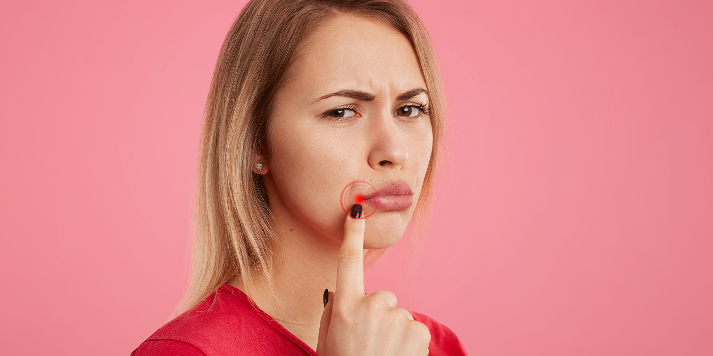 Comment traiter l'herpès labial?