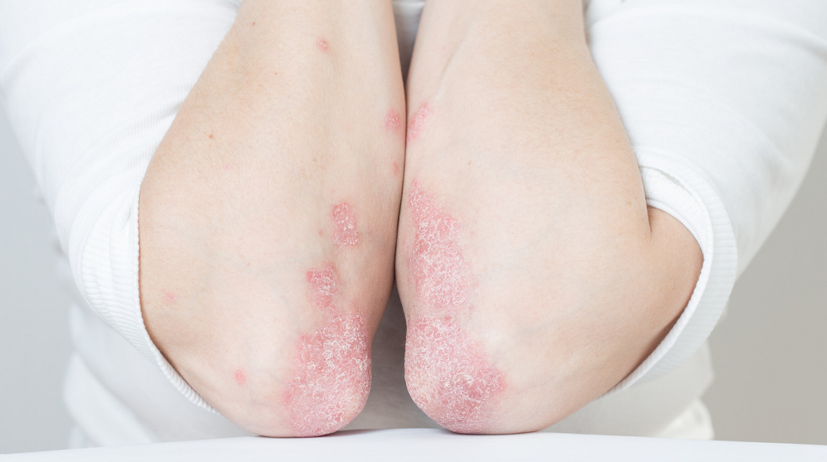 Psoriasis au quotidien : mieux comprendre ses impacts et retrouver plus de confort